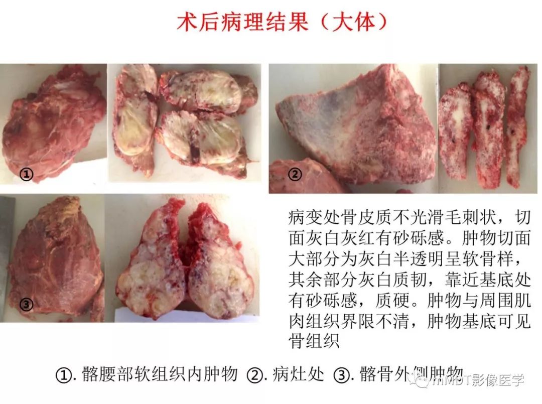 【病例】髂骨骨肉瘤1例CT及MR影像诊断分析 【病例】髂骨骨肉瘤1例CT及MR影像诊断分析