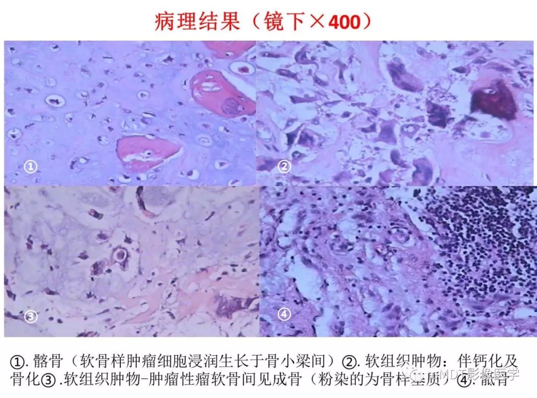【病例】髂骨骨肉瘤1例CT及MR影像诊断分析 【病例】髂骨骨肉瘤1例CT及MR影像诊断分析