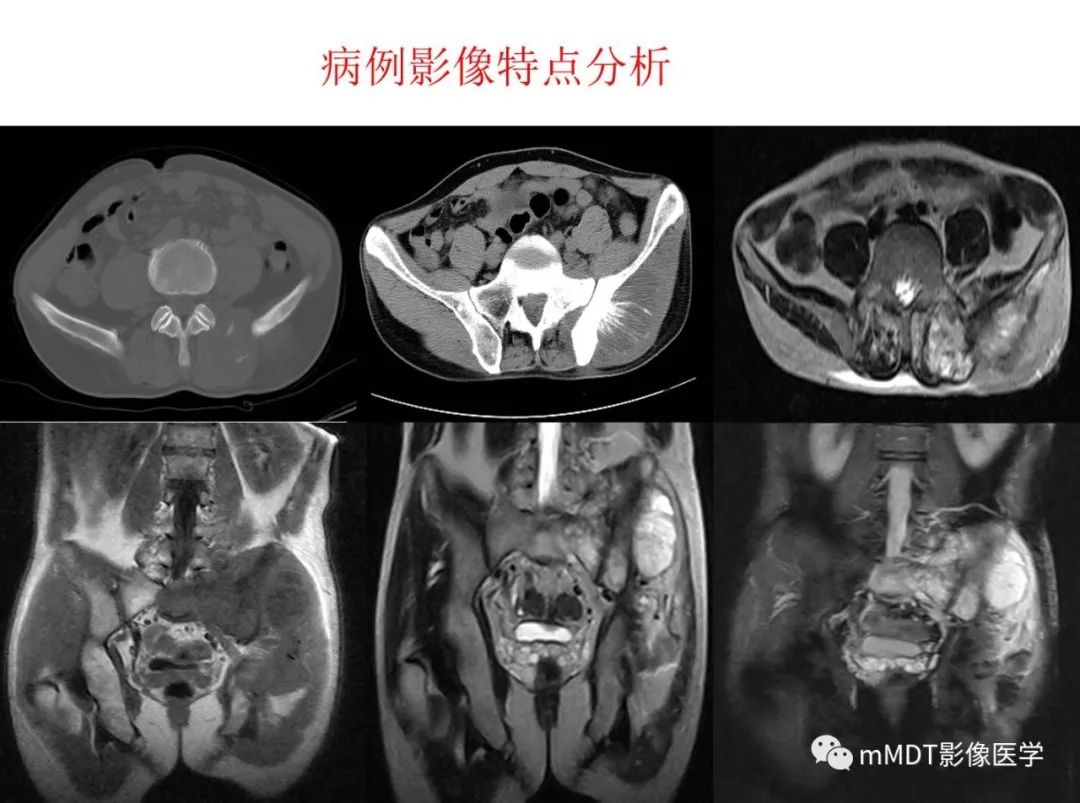 【病例】髂骨骨肉瘤1例CT及MR影像诊断分析 【病例】髂骨骨肉瘤1例CT及MR影像诊断分析