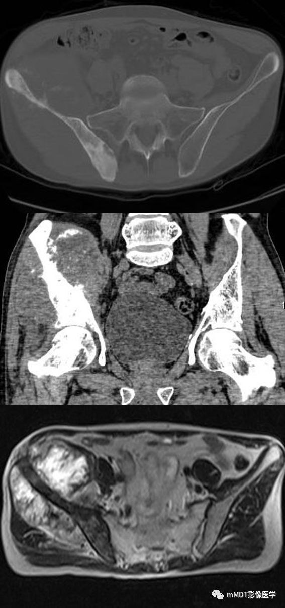 【病例】髂骨骨肉瘤1例CT及MR影像诊断分析 【病例】髂骨骨肉瘤1例CT及MR影像诊断分析