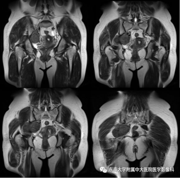 【病例】盆壁孤立性纤维瘤1例CT及MR