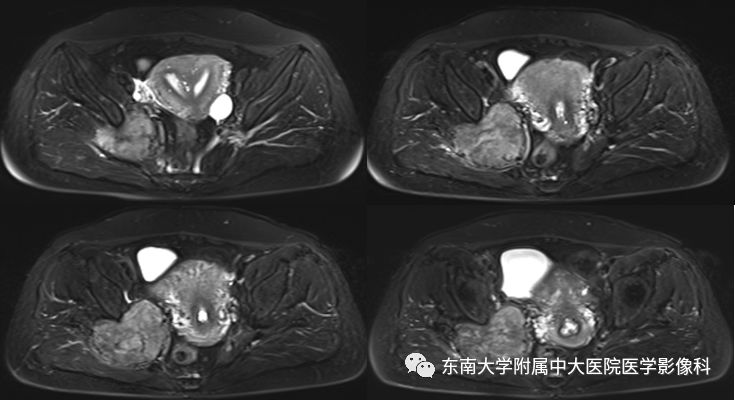 【病例】盆壁孤立性纤维瘤1例CT及MR