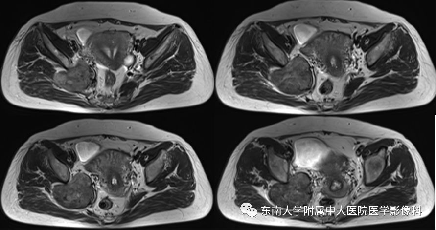 【病例】盆壁孤立性纤维瘤1例CT及MR