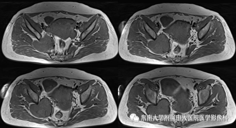 【病例】盆壁孤立性纤维瘤1例CT及MR