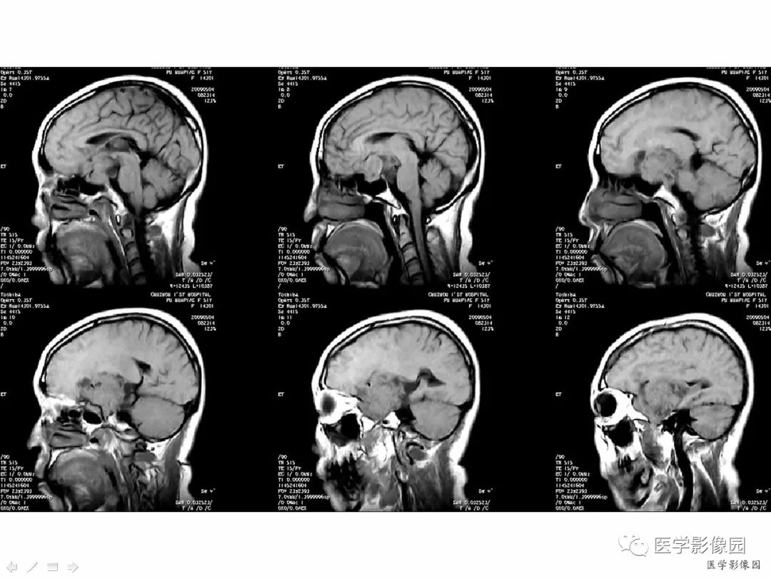 【病例】侵袭性垂体瘤1例CT及MR影像表现 【病例】侵袭性垂体瘤1例CT及MR影像表现