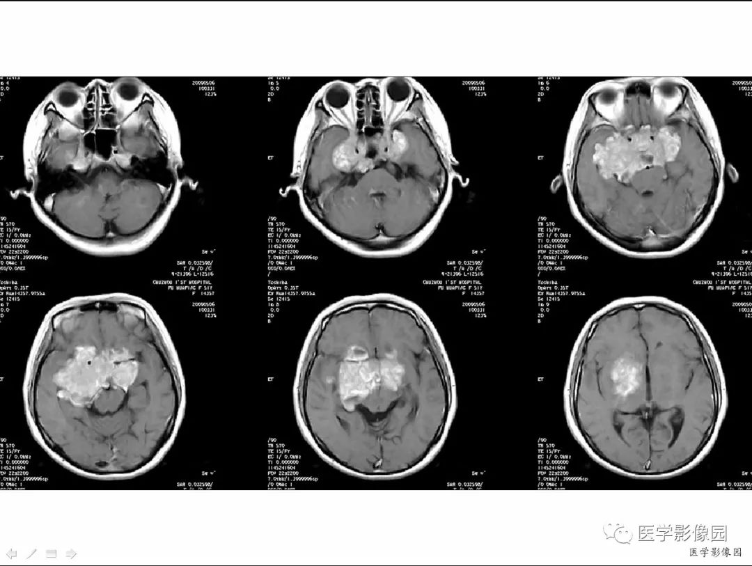 【病例】侵袭性垂体瘤1例CT及MR影像表现 【病例】侵袭性垂体瘤1例CT及MR影像表现