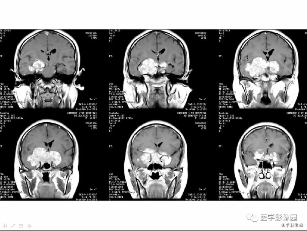 【病例】侵袭性垂体瘤1例CT及MR影像表现