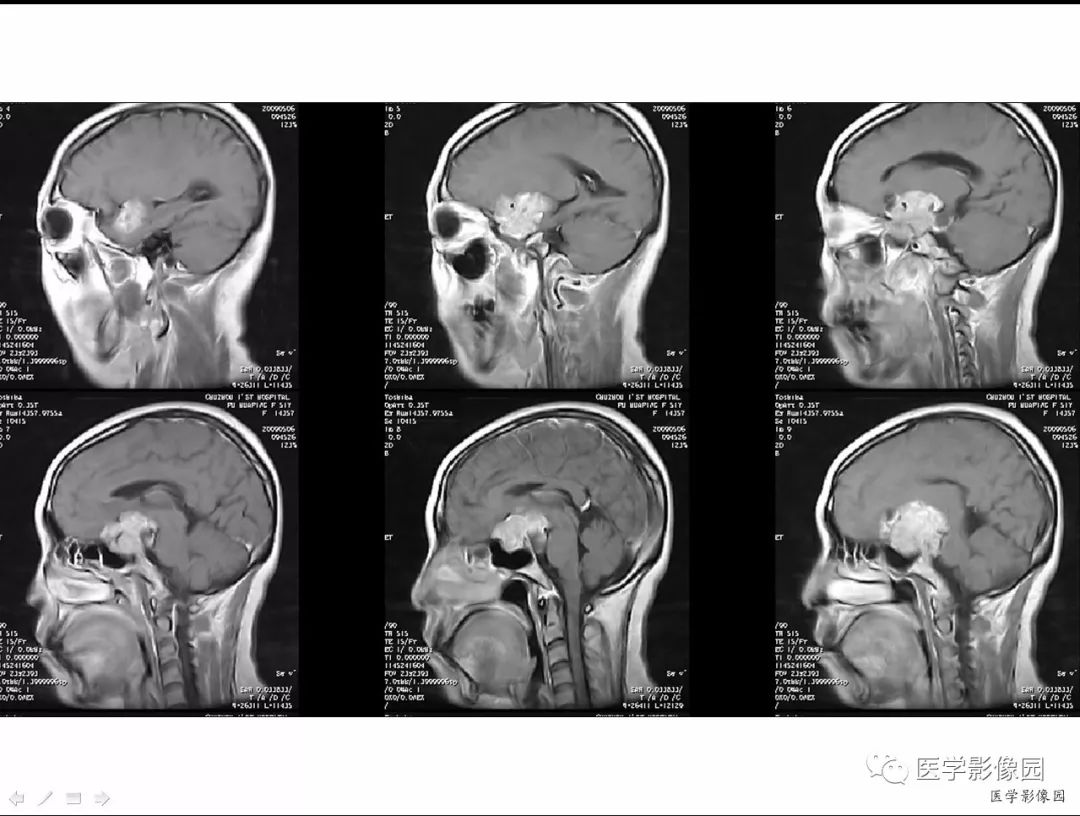 【病例】侵袭性垂体瘤1例CT及MR影像表现 【病例】侵袭性垂体瘤1例CT及MR影像表现