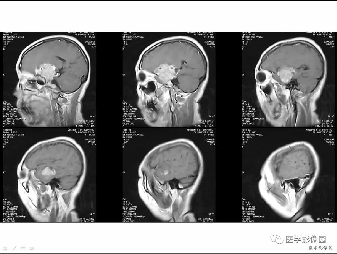 【病例】侵袭性垂体瘤1例CT及MR影像表现 【病例】侵袭性垂体瘤1例CT及MR影像表现