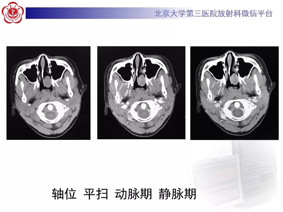 【病例】鼻咽纤维血管瘤1例CT及MR影像诊断