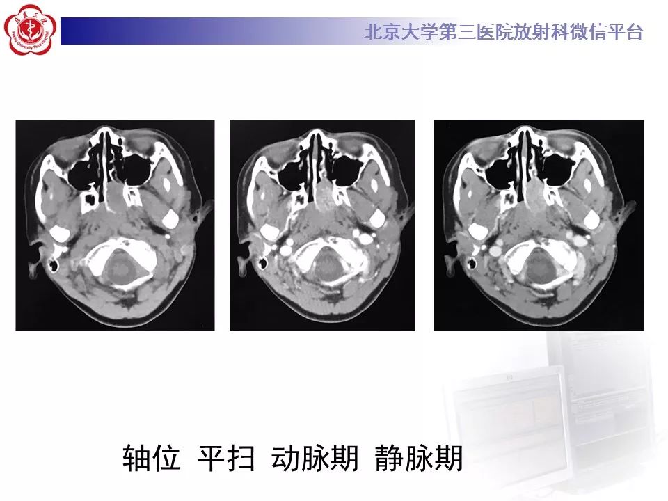 【病例】鼻咽纤维血管瘤1例CT及MR影像诊断