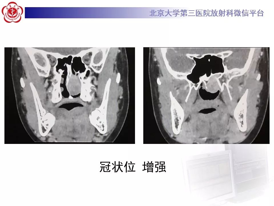 【病例】鼻咽纤维血管瘤1例CT及MR影像诊断