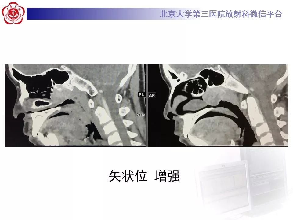 【病例】鼻咽纤维血管瘤1例CT及MR影像诊断