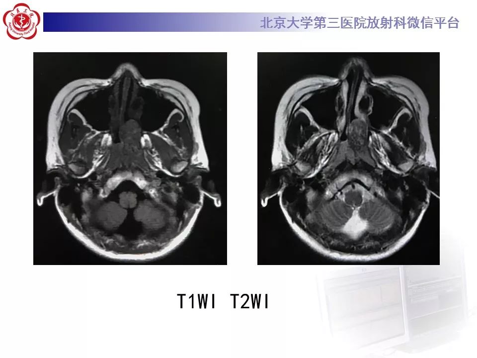 【病例】鼻咽纤维血管瘤1例CT及MR影像诊断