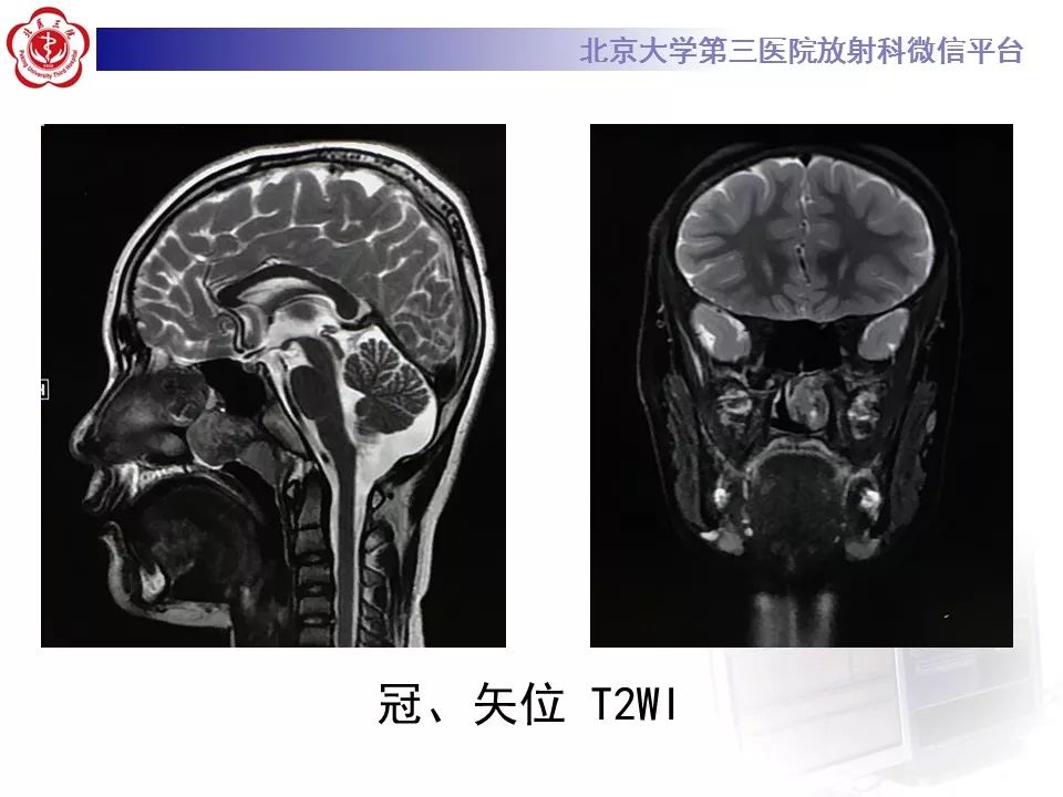 【病例】鼻咽纤维血管瘤1例CT及MR影像诊断
