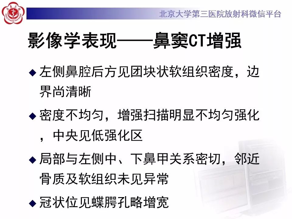 【病例】鼻咽纤维血管瘤1例CT及MR影像诊断