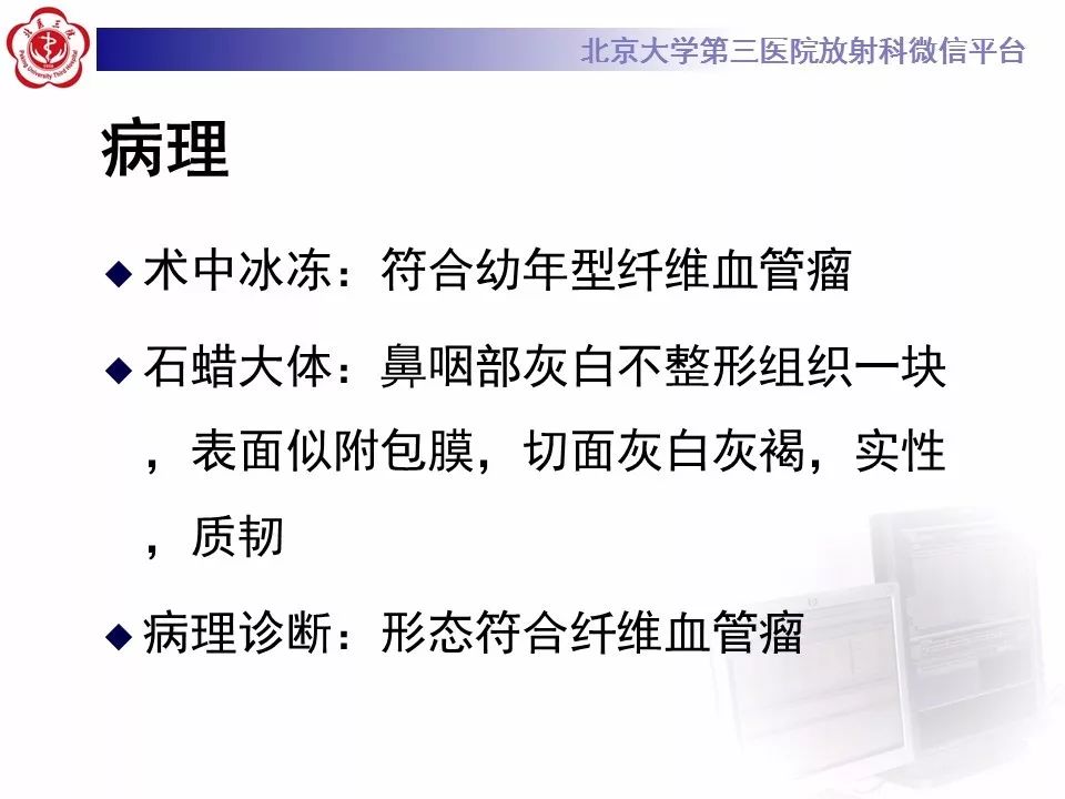 【病例】鼻咽纤维血管瘤1例CT及MR影像诊断