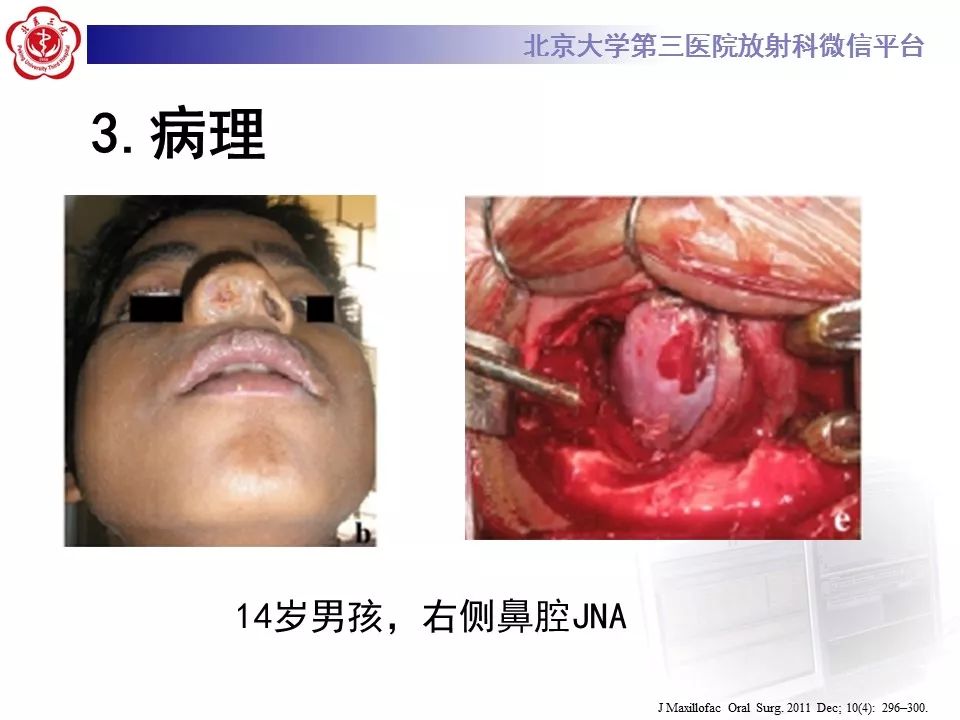 【病例】鼻咽纤维血管瘤1例CT及MR影像诊断