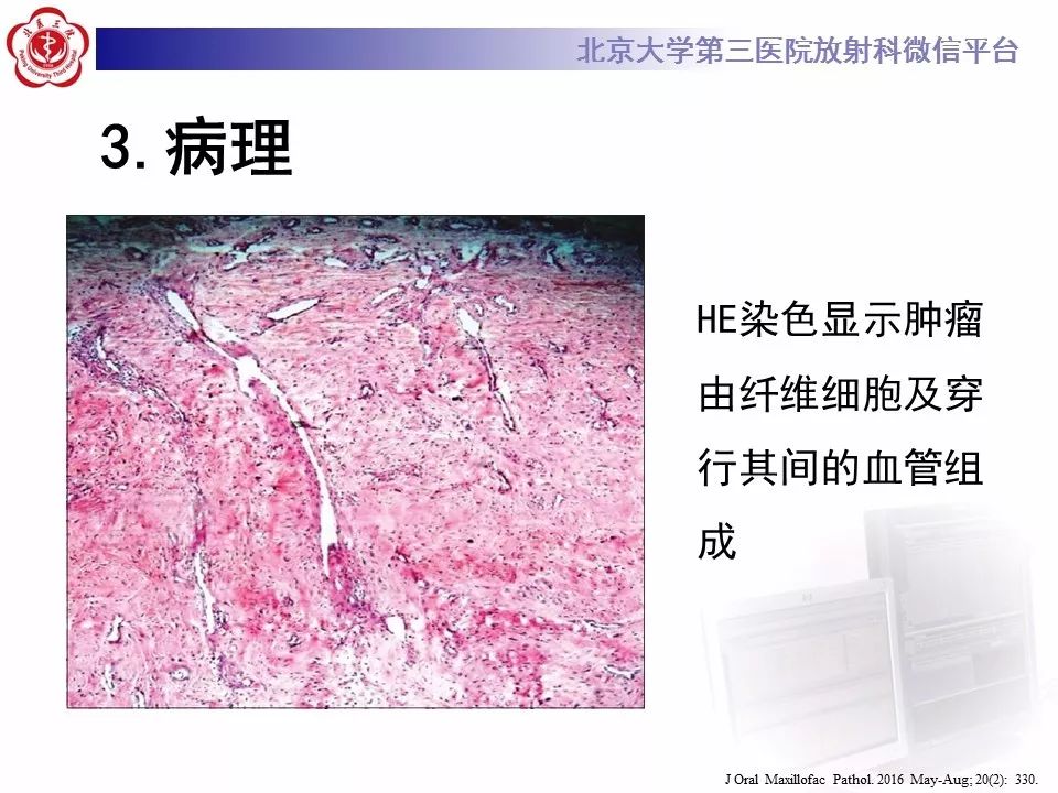 【病例】鼻咽纤维血管瘤1例CT及MR影像诊断