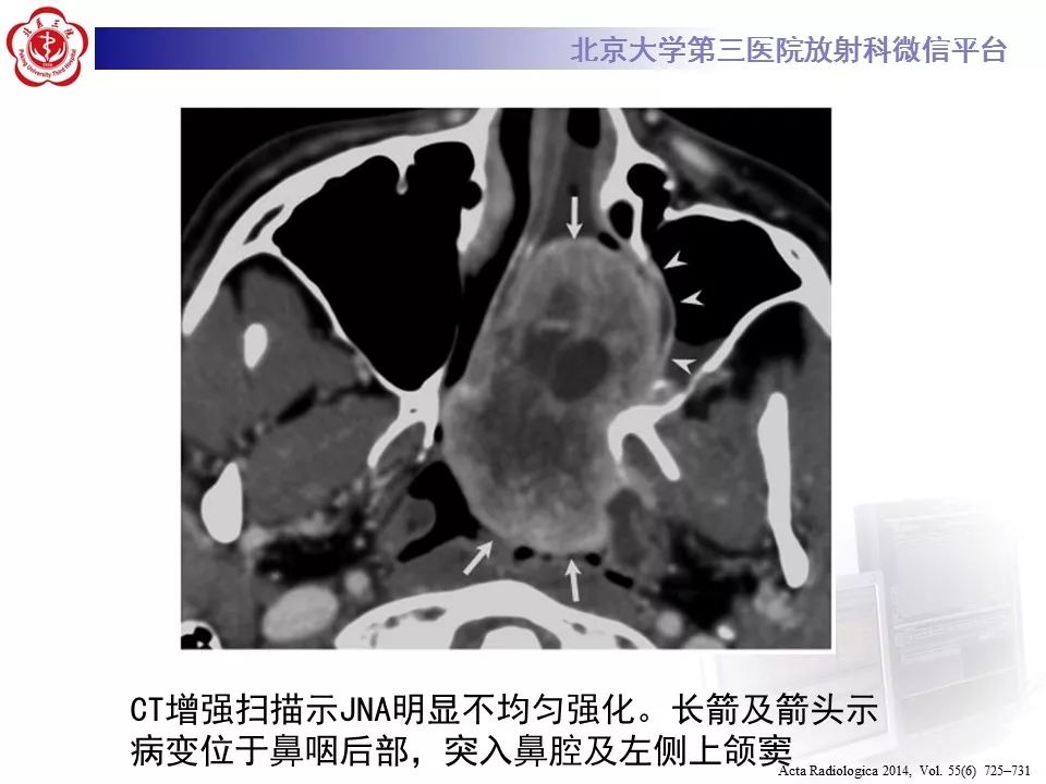 【病例】鼻咽纤维血管瘤1例CT及MR影像诊断