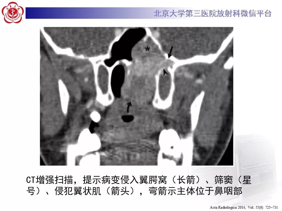 【病例】鼻咽纤维血管瘤1例CT及MR影像诊断
