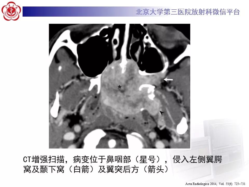 【病例】鼻咽纤维血管瘤1例CT及MR影像诊断