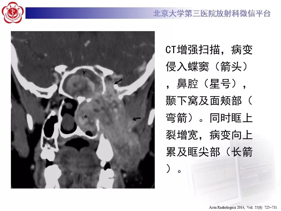 【病例】鼻咽纤维血管瘤1例CT及MR影像诊断