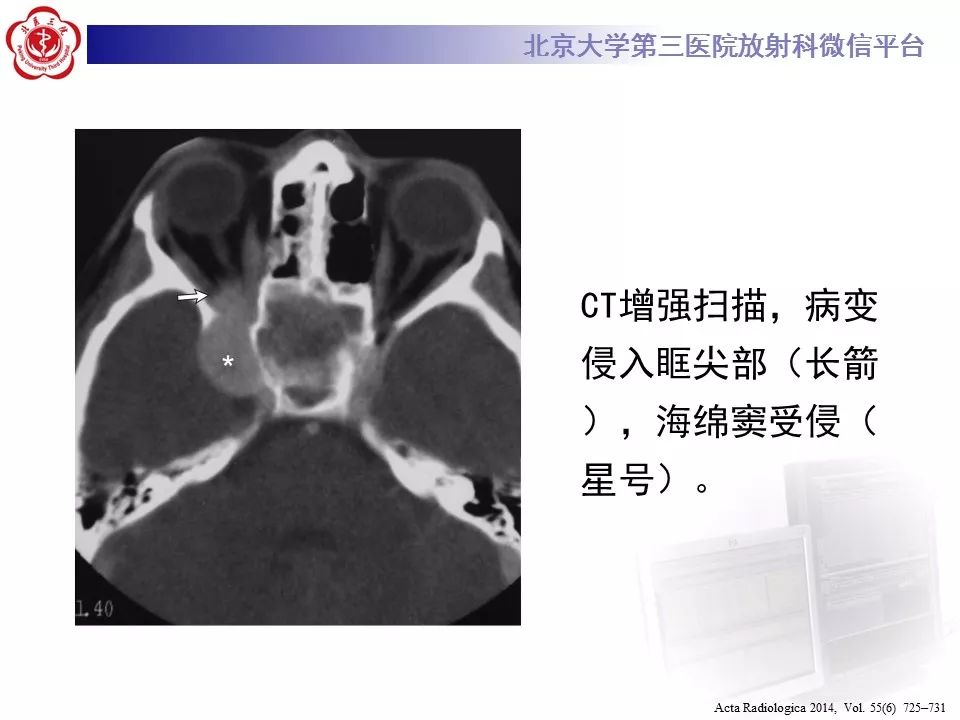 【病例】鼻咽纤维血管瘤1例CT及MR影像诊断