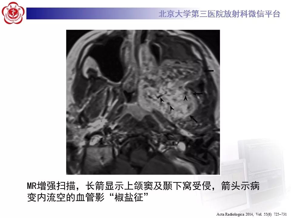 【病例】鼻咽纤维血管瘤1例CT及MR影像诊断