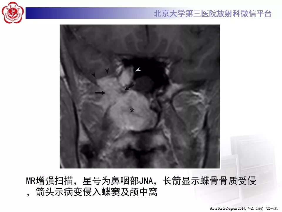 【病例】鼻咽纤维血管瘤1例CT及MR影像诊断