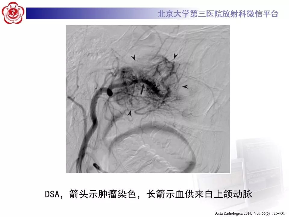 【病例】鼻咽纤维血管瘤1例CT及MR影像诊断