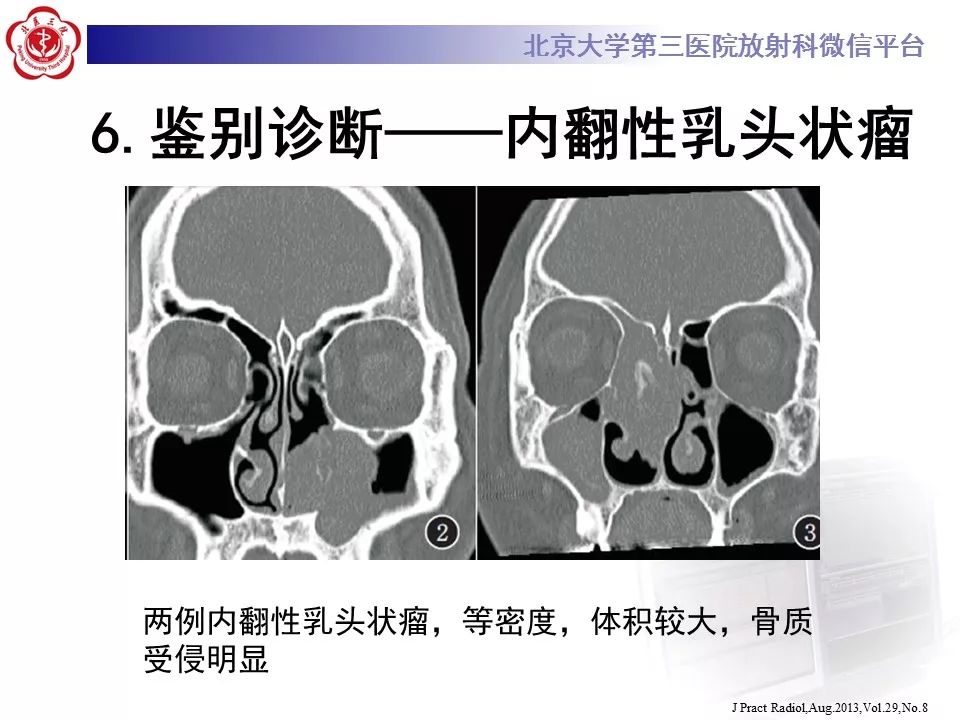 【病例】鼻咽纤维血管瘤1例CT及MR影像诊断