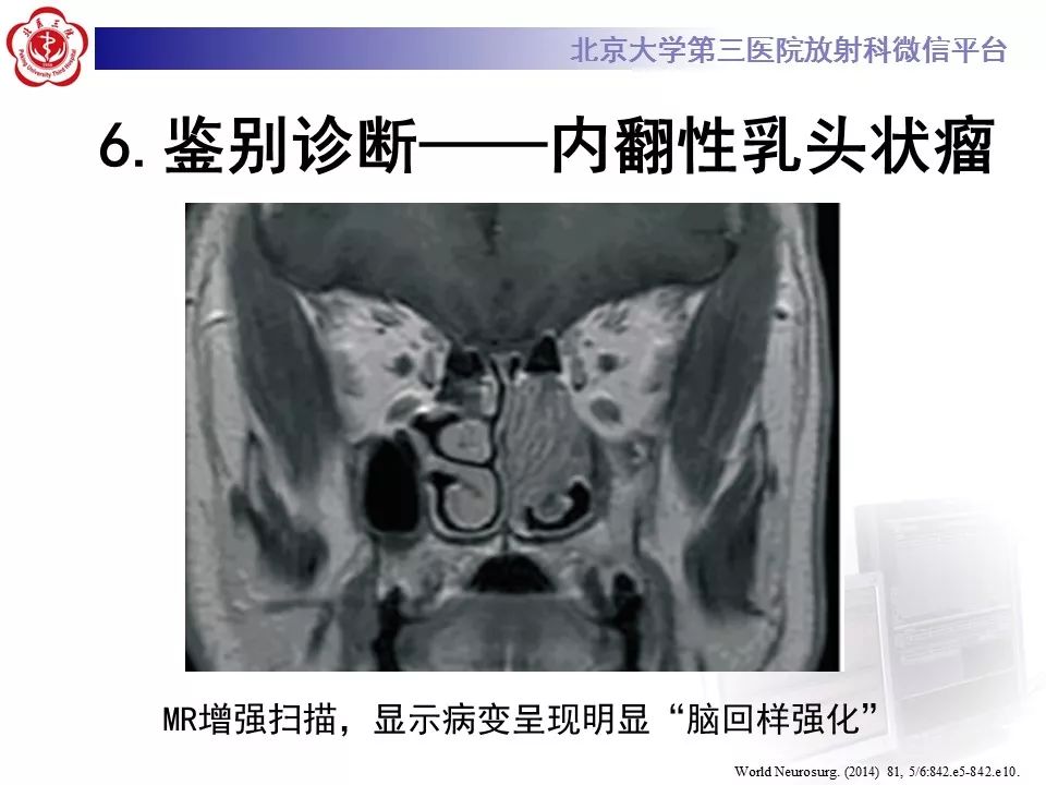 【病例】鼻咽纤维血管瘤1例CT及MR影像诊断