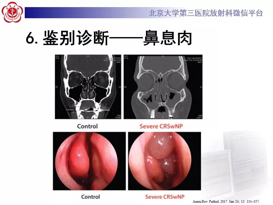 【病例】鼻咽纤维血管瘤1例CT及MR影像诊断