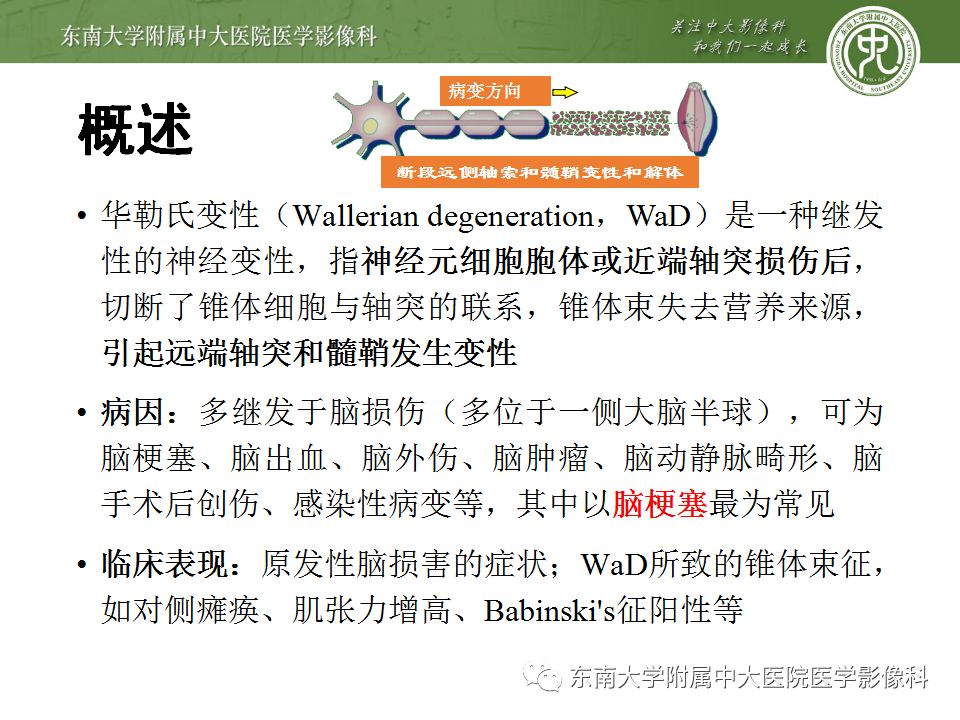 【病例】华勒氏变性1例CT及MR影像诊断