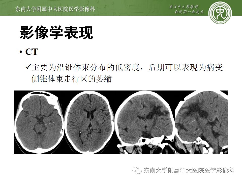 【病例】华勒氏变性1例CT及MR影像诊断