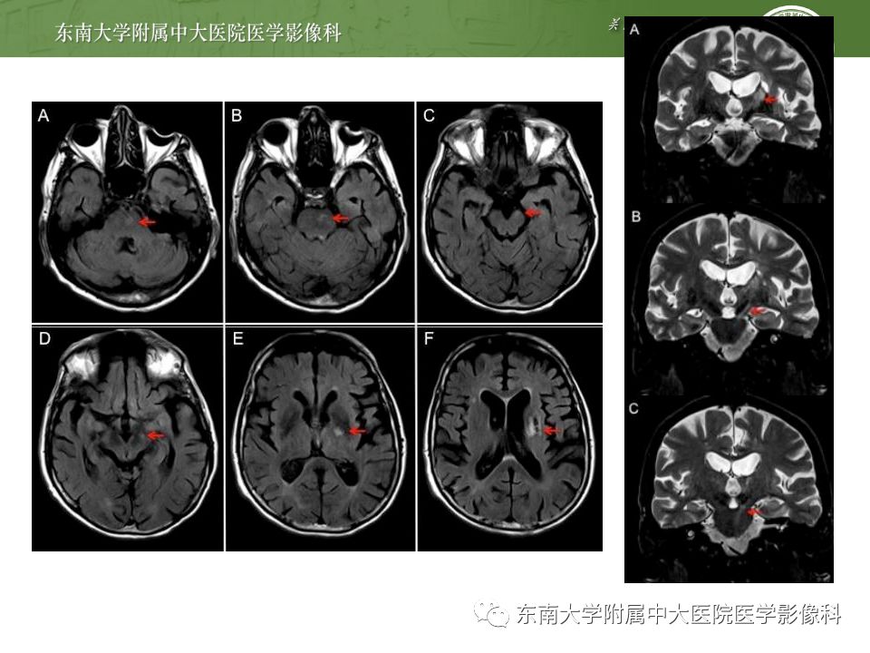 【病例】华勒氏变性1例CT及MR影像诊断