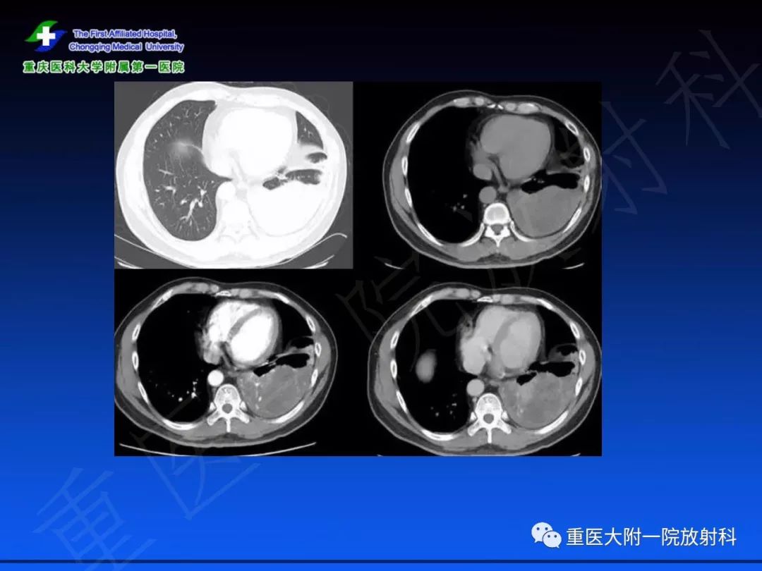 【PPT】孤立性纤维瘤的影像学诊断及鉴别诊断