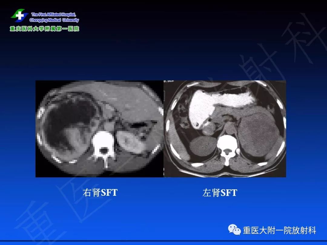 【PPT】孤立性纤维瘤的影像学诊断及鉴别诊断
