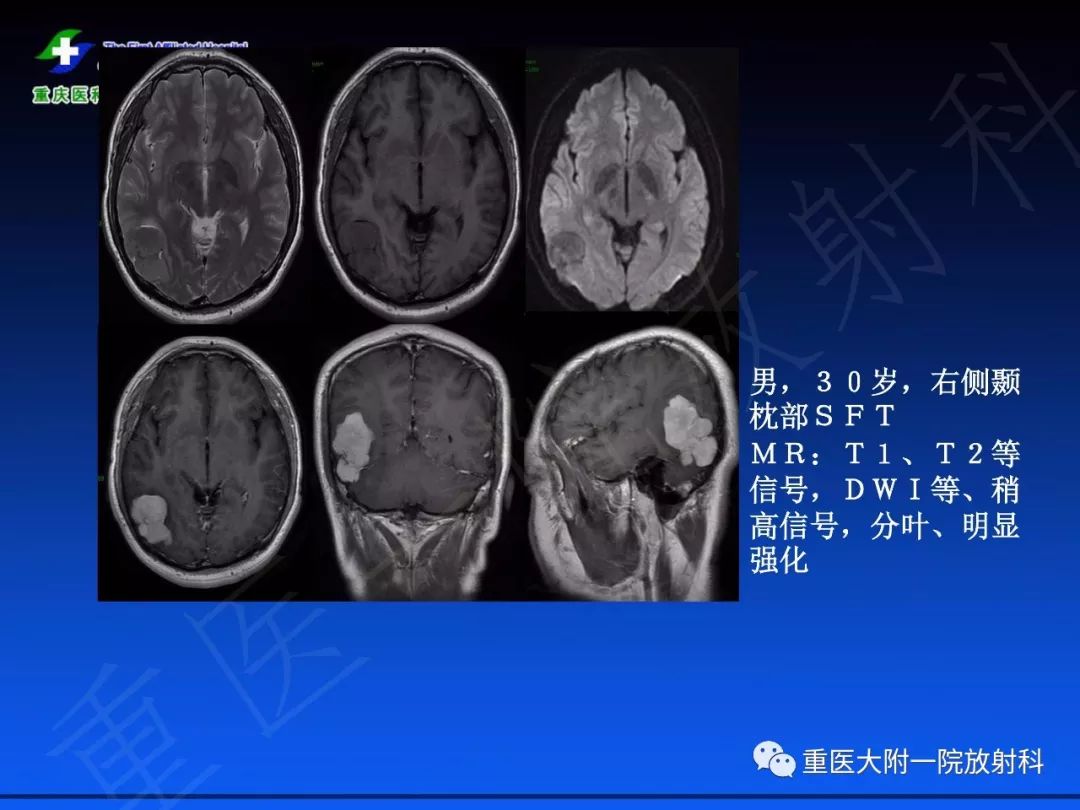 【PPT】孤立性纤维瘤的影像学诊断及鉴别诊断