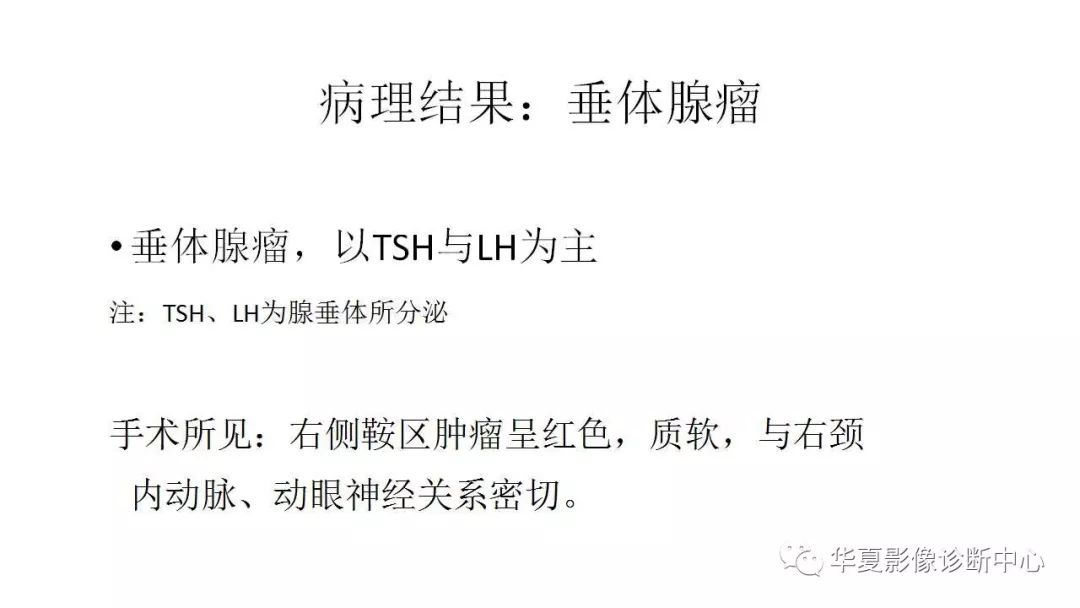 【病例】侵袭性垂体瘤1例CT及MR