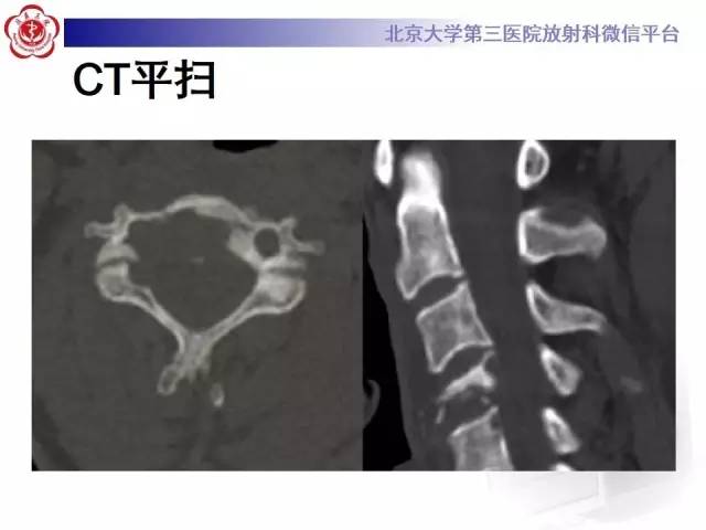 【病例】脊柱朗格汉斯组织细胞增生症1例CT及MR影像诊断