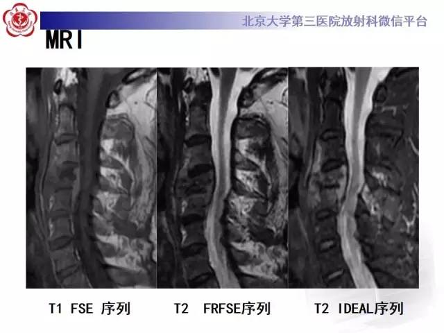【病例】脊柱朗格汉斯组织细胞增生症1例CT及MR影像诊断