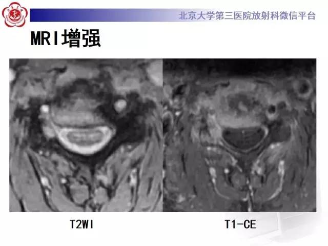 【病例】脊柱朗格汉斯组织细胞增生症1例CT及MR影像诊断