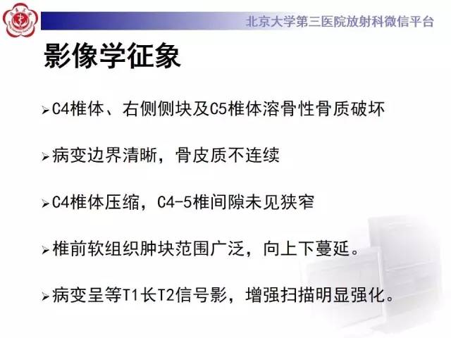 【病例】脊柱朗格汉斯组织细胞增生症1例CT及MR影像诊断