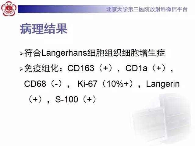 【病例】脊柱朗格汉斯组织细胞增生症1例CT及MR影像诊断