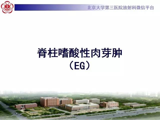 【病例】脊柱朗格汉斯组织细胞增生症1例CT及MR影像诊断