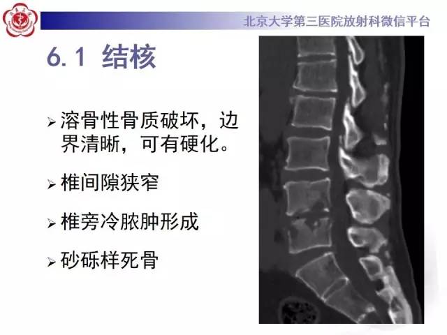 【病例】脊柱朗格汉斯组织细胞增生症1例CT及MR影像诊断