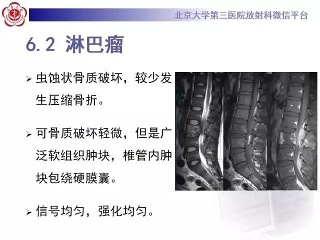 【病例】脊柱朗格汉斯组织细胞增生症1例CT及MR影像诊断