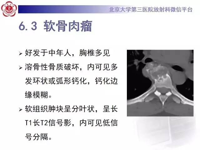 【病例】脊柱朗格汉斯组织细胞增生症1例CT及MR影像诊断